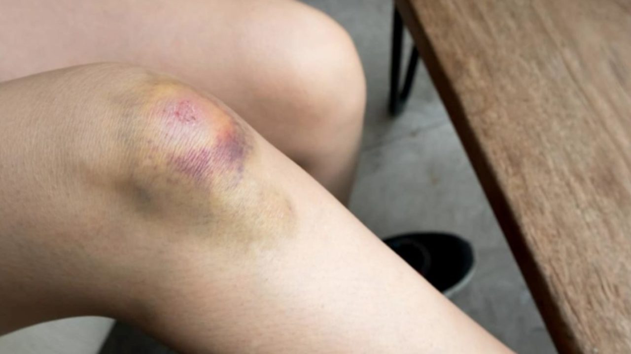 hematoma kancer 1280x720